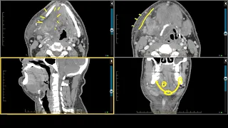 Pathology of the Oral Cavity and Oropharynx - Ludwig’s Angina