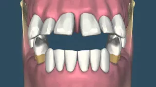 Perda dental e suas consequências - vídeo 3