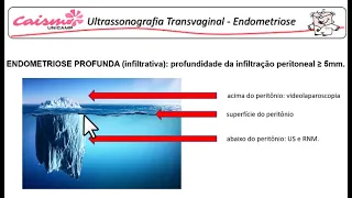 Ultrassonografia transvaginal na endometriose profunda