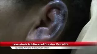 Levamisole Adulterated Cocaine Vasculitis