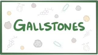 Gallstones (cholelithiasis) - causes, symptoms, diagnosis, treatment & pathology