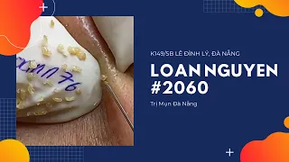 #2060 | LOAN NGUYEN SPA