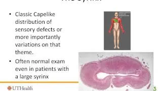 Pediatric Chiari Malformation - Dr. Stephen Fletcher