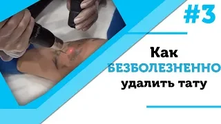 Как БЕЗБОЛЕЗНЕННО удалить тату - это стало возможно! [0+]