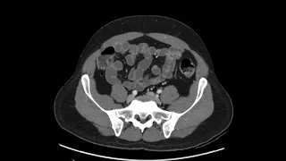 How to read a CT of the Abdomen and Pelvis - a quick, practical approach (axial)