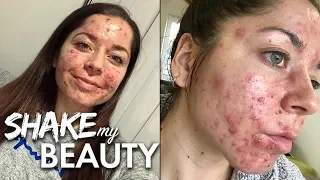 Doctors Told Me I Had The Worst Acne They’d Ever Seen | SHAKE MY BEAUTY