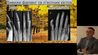 Променева діагностика травм кисті Симчич Ю , Кметюк В М , Івано Франківськ