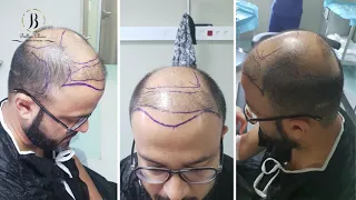 Hair transplant result / Bellus Clinic / Результат пересадки волос