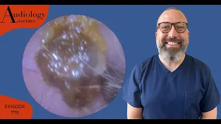 EAR WAX REMOVAL COMPILATION INC 8 YEAR OLDS EAR WAX REMOVAL - EP775