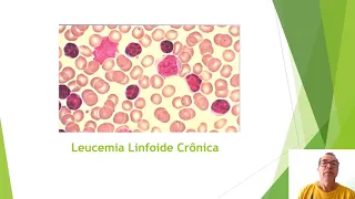 Leucemia- Hematologia Clínica