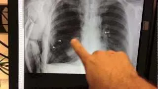 LARGE PNEUMOTHORAX - COLLAPSED LUNG