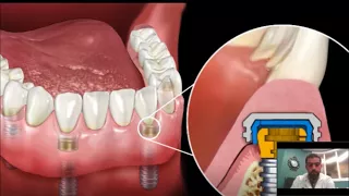 Dental Implant Overdenture | Snap-In Dentures