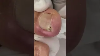 Part 5 | Ingrown Toenail #pedicure #satisfying #satisfyingvideo #ingrown_toenail