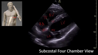 Subcostal Four chamber View. Perioperative & Critical Care ECHO/ POCUS