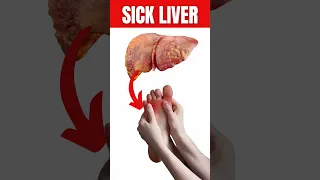 What Are Symptoms Of A Diseased Liver On The Skin And Feet?