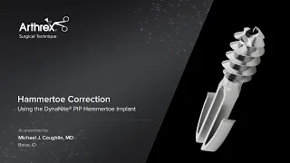 Hammertoe Correction Using the DynaNite® PIP Hammertoe Implant
