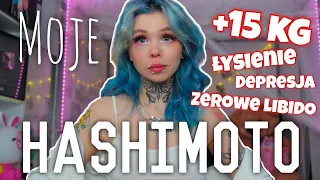 ♦️Jak żyję z HASHIMOTO?♦️Moja Historia