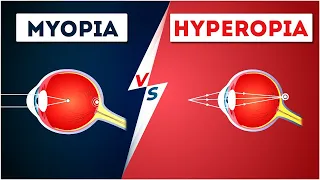 Difference between Myopia and hyperopia In Hindi | Letstute Hindi