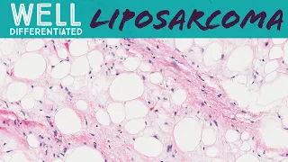 Well differentiated liposarcoma aka atypical lipomatous tumor (pathology sarcoma soft tissue tumor)