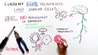 Whiteboard: Multiple Sclerosis