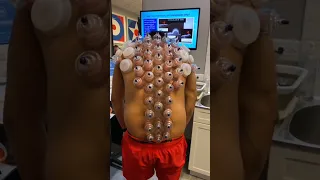 Hijama 😲 (Cupping Therapy!)😫 #shorts #cupping #youtubeshorts #ytshorts #viral #trending #hijama  #pc