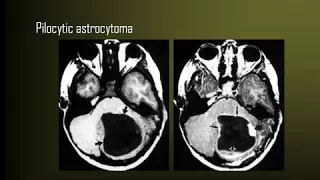 Radiology Course Dr Mamdouh Mahfouz Brain tumors II