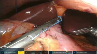 Robotic Biliopancreatic Diversion with Duodenal Switch (80 min)