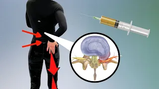 PRP Epidural For Radiculopathy | What Is The Evidence?