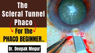 The scleral tunnel phacoemulsification for beginner surgeons - Dr. Deepak Megur