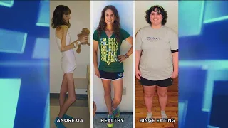 How an Anorexic Can Become a Binge Eater