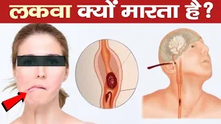 लकवा क्यों होता है? क्या लकवा का मरीज ठीक हो सकता है? Paralysis and it's Causes | Brain stroke