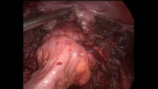 Laparoscopic Management of Multiple  Recto-sigmoid Lesions of  Endometriosis by Dr.Pragnesh Shah MD