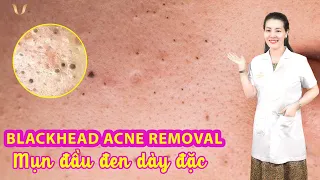 Blackhead Acne Removal | Điều trị mụn ẩn, mụn đầu đen hiệu quả TPHCM | Hiền Vân Spa |560