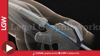 Mid Femur Frac IM Nailing Surgery 3D animation