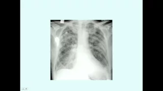 Acute Respiratory Distress Syndrome - CRASH! Medical Review Series