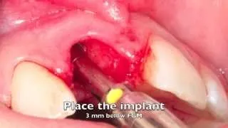 *New - Dental Implant - Temporization with Dr Scott MacLean