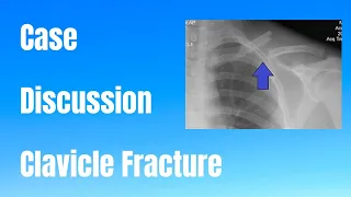 Clavicle Fracture || Case Discussion
