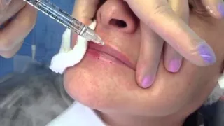 Биоревитализация  Увлажнение губ