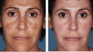 Dr Rajdeep Mysore explaining about Skin Darkening & Pigmentation during Pregnancy | Treatment