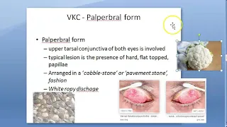 Ophthalmology 088 b Vernal KeratoPathy VKC Shield ulceration Cornea Eye PseudoGeronToxon Types