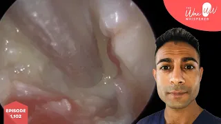 1,102 - Nasty 5 Year Ear Infection Microsuction