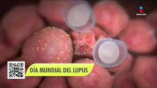 Lupus: tipos, síntomas y tratamiento | Noticias con Francisco Zea