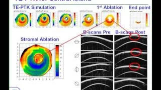 LoVC Course on Therapeutic Corneal Refractive Surgery Part 6 (of 6): Protocol for TE-PTK