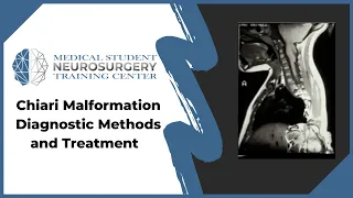 Chiari Malformation Diagnostic Methods and Treatment