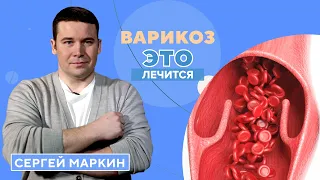 Все о варикозе: виды, профилактика, эффективные методы лечения