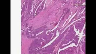 Histopathology Kidney--Transitional cell carcinoma