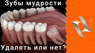 ЗУБЫ МУДРОСТИ | 5 причин удалить и 4 - оставить. Взгляд ортодонта.