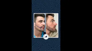 Beard Transplant - 9 Months Result of Liam!