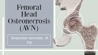 Femoral Head Osteonecrosis (AVN) - Avascular necrosis  of hip