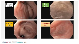 Post-operative care and neovagina care